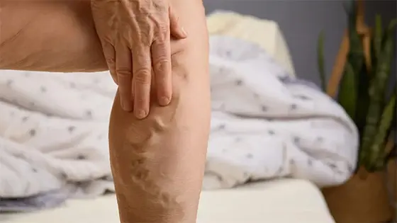 Vena con várices - Video explicativo